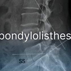 Spondylolisthesis, avagy a csigolya elcsúszás