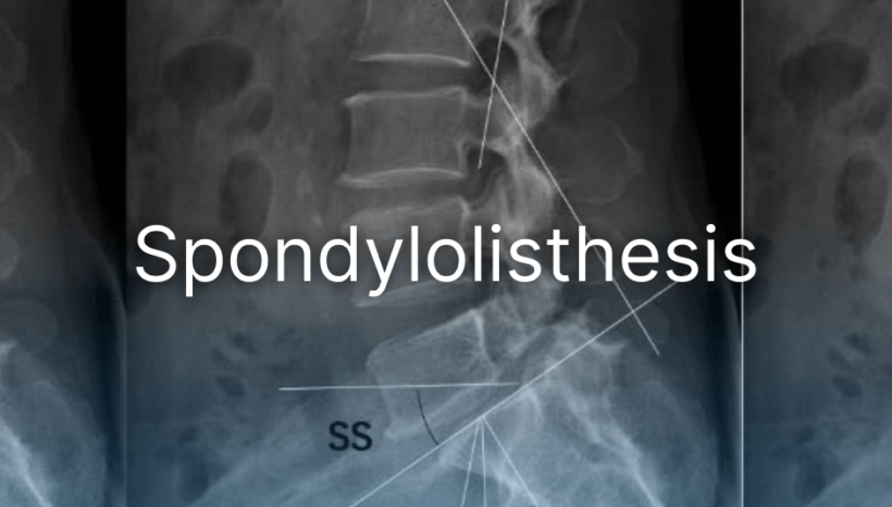 Spondylolisthesis, avagy a csigolya elcsúszás